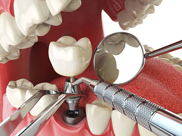 Best Emergency Treatment for Dental Infections or Abscesses in Greensburg, LA